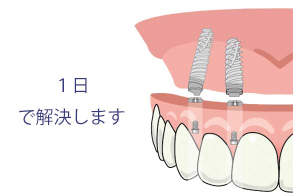 １日で解決　オールオン4