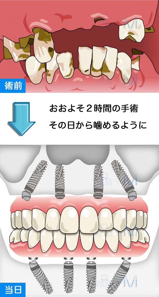 オールオン4 その日に歯が入る