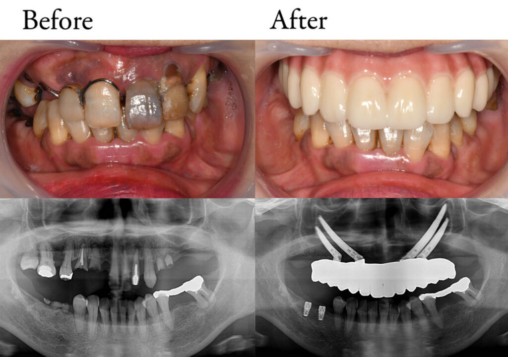 オールオン4 症例