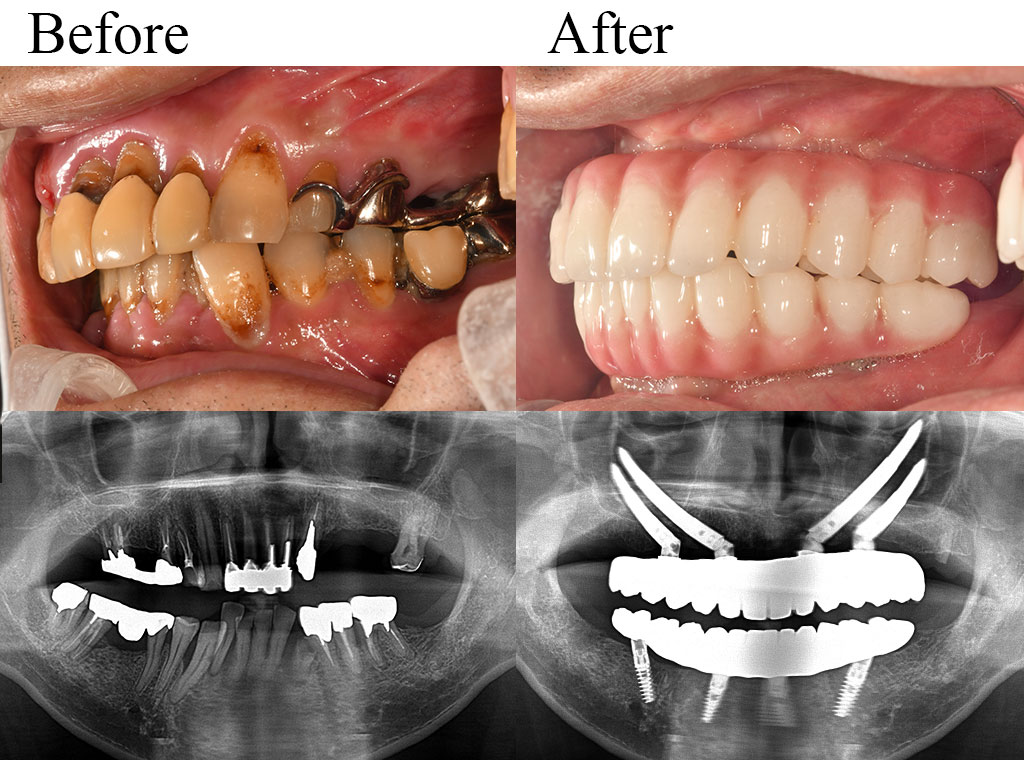 allon4 case01