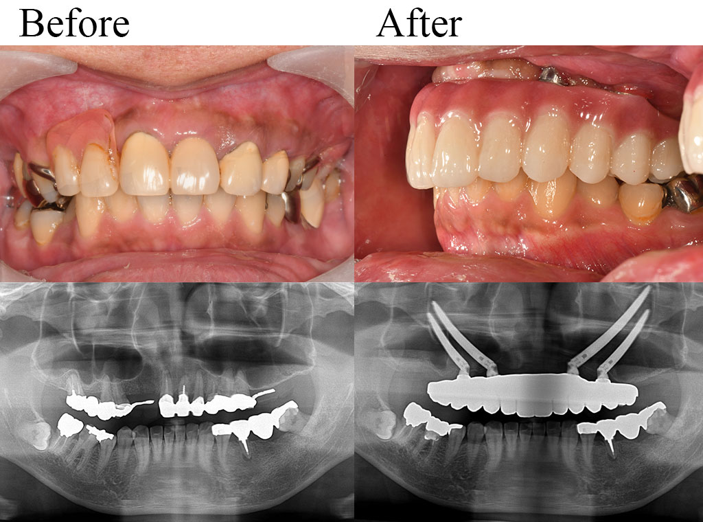 allon4 case02
