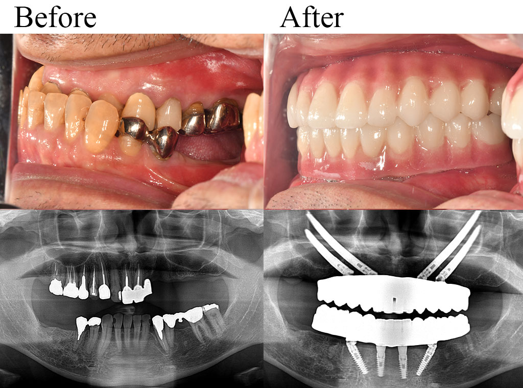 allon4 case03