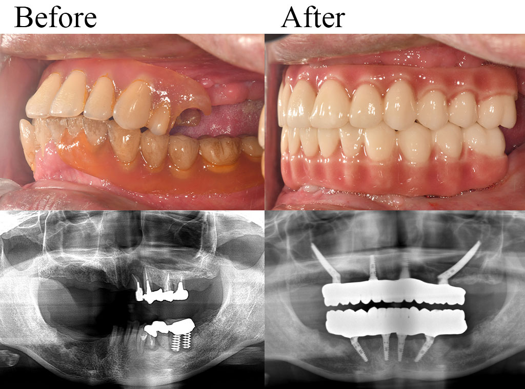 allon4 case04
