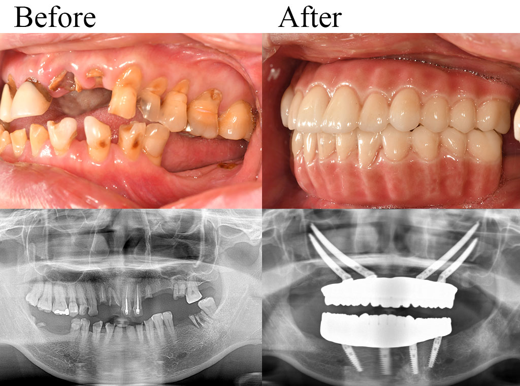 allon4 case05