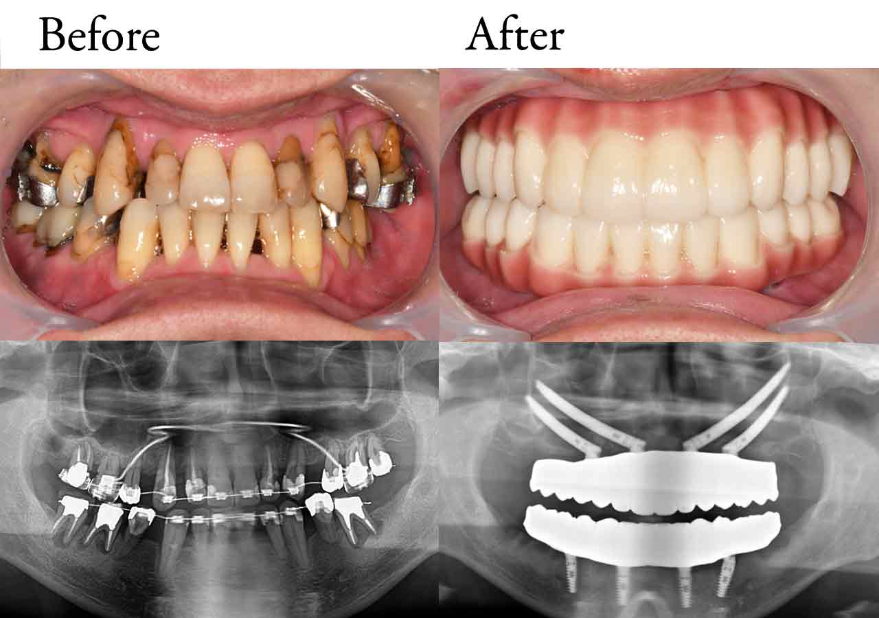 smile_allon4-case1