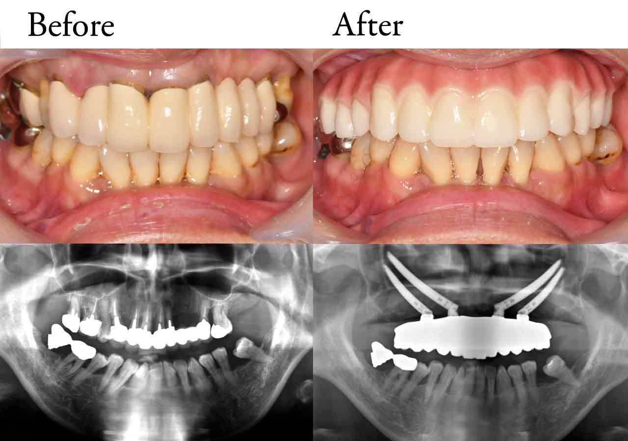 smile_allon4-case2