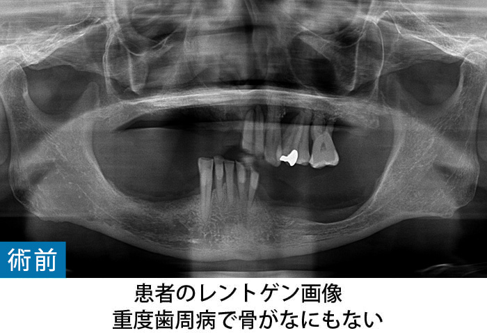 歯　ボロボロ　噛めない　