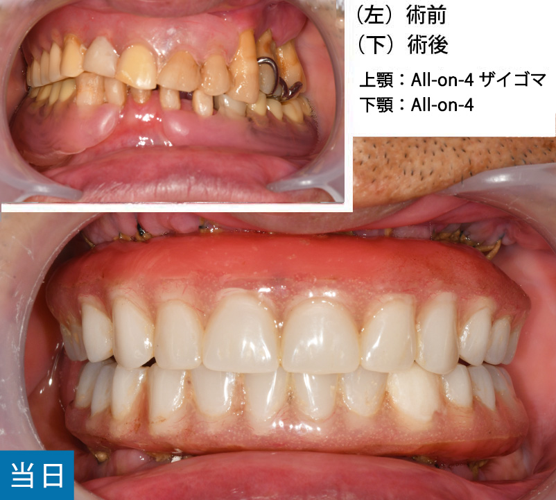 仮歯　噛めない