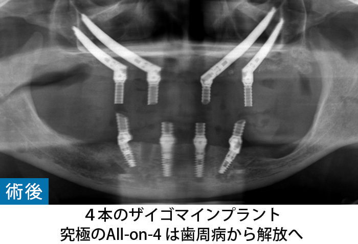 ザイゴマインプラント　専門医