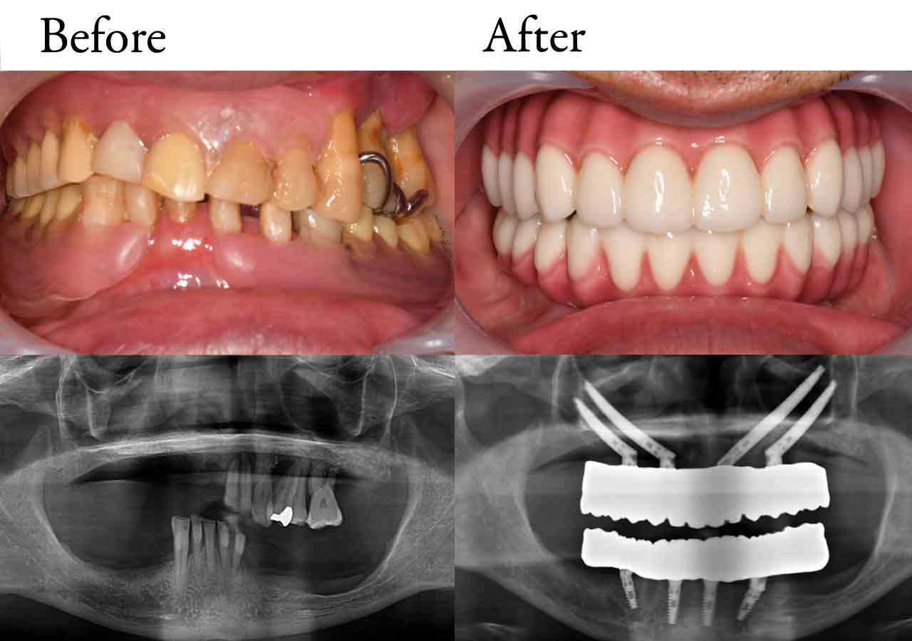 allon4-case01