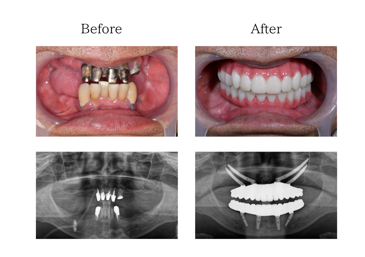 オールオン４　体験談