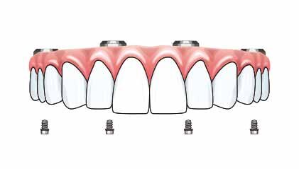 All-on-4 ( オールオン4 )