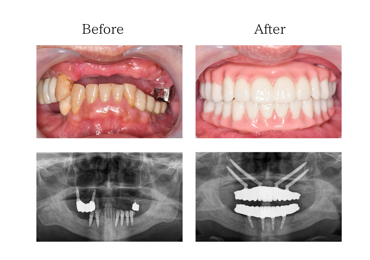 オールオン４　体験談