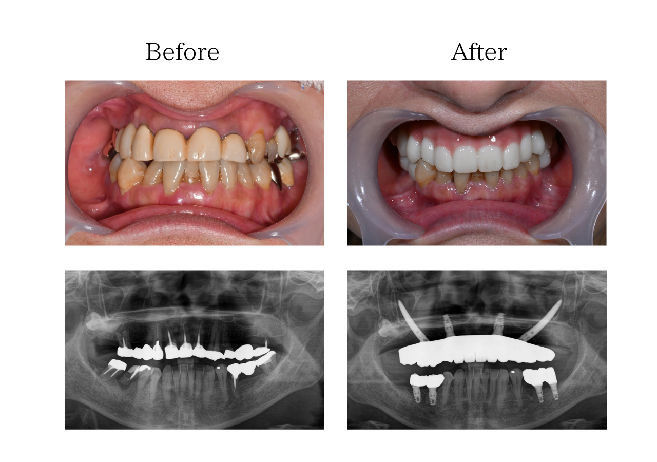 ザイゴマインプラント　体験談