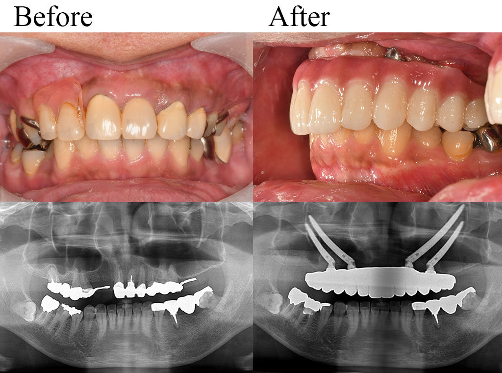allon4 case02