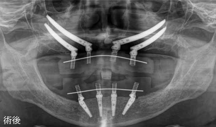 クワッド　ザイゴマ
