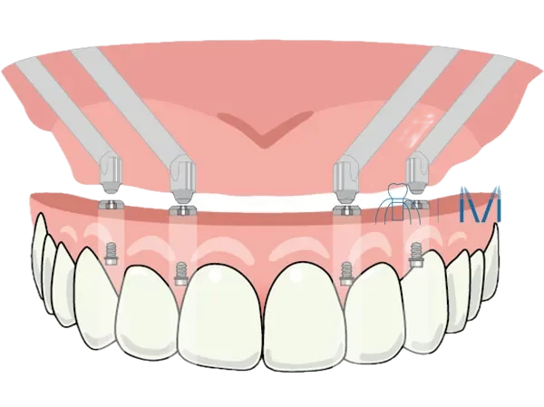 オールオン4ザイゴマ　イラスト