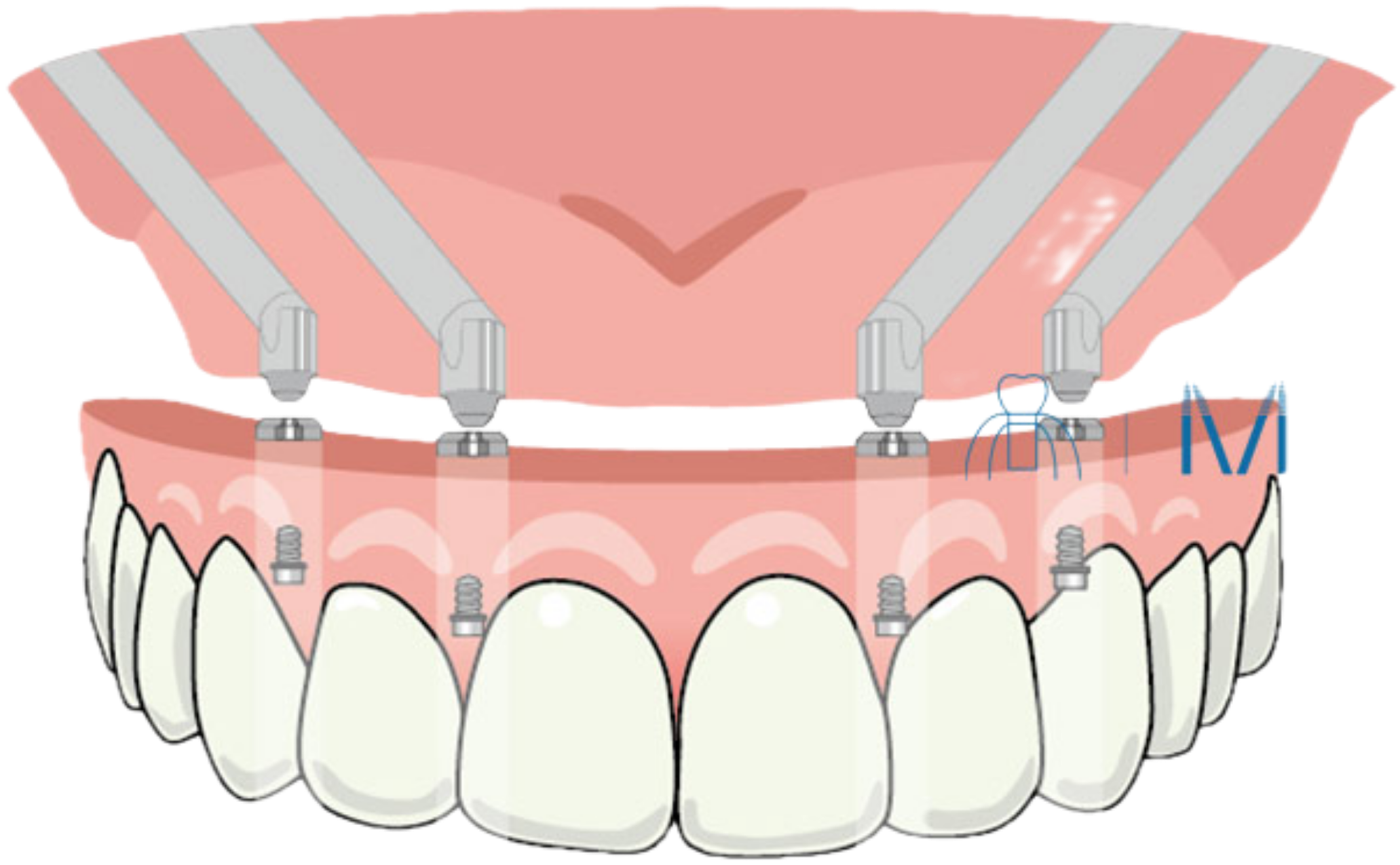 オールオン4ザイゴマイラスト