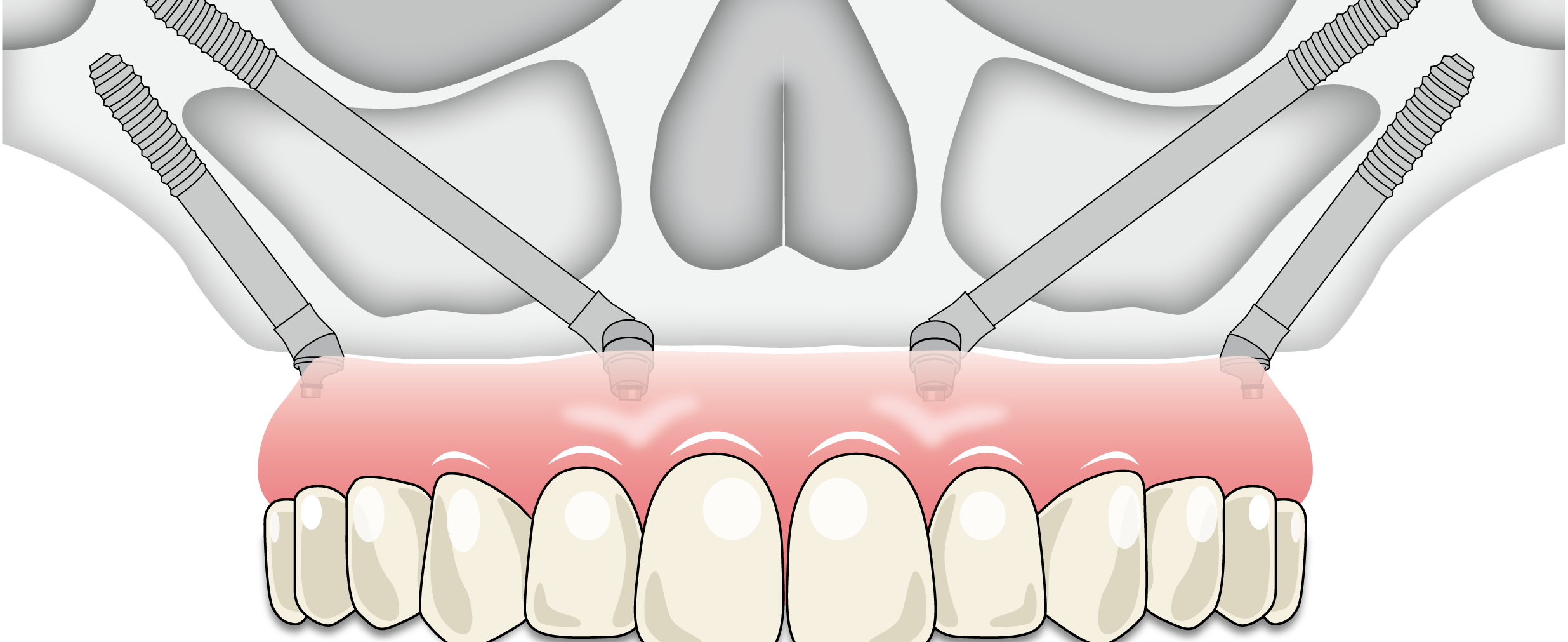 オールオン４ザイゴマ上顎
