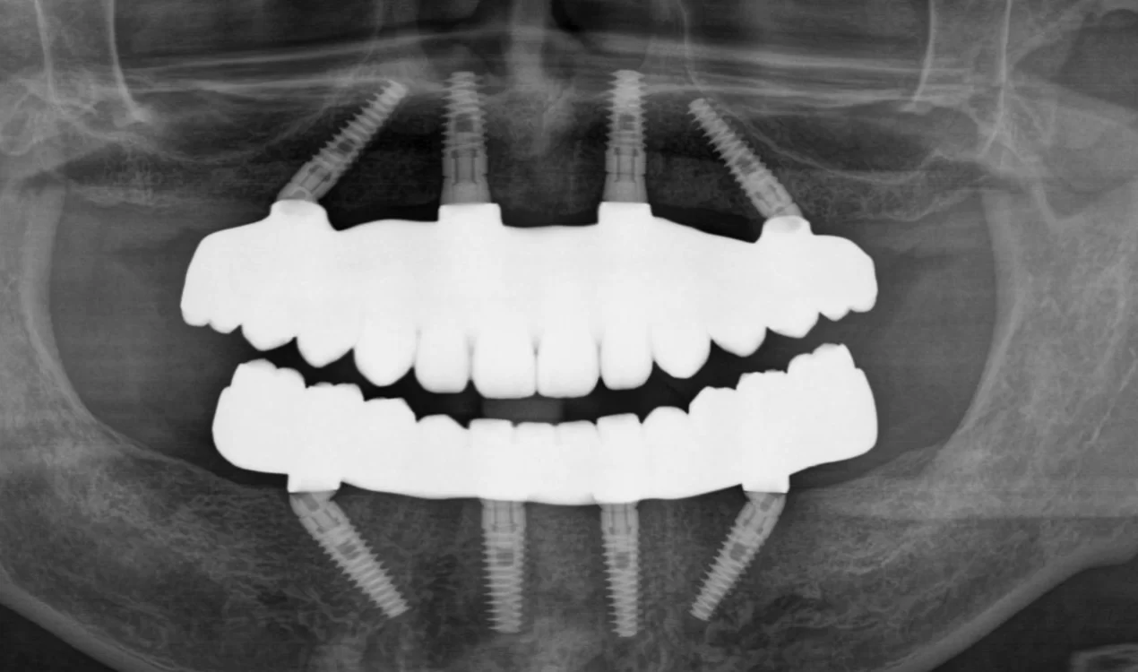 オールオン4（ザイゴマ0）プラン。上顎骨が十分にある方向けの最小4本のインプラントによる全歯再建