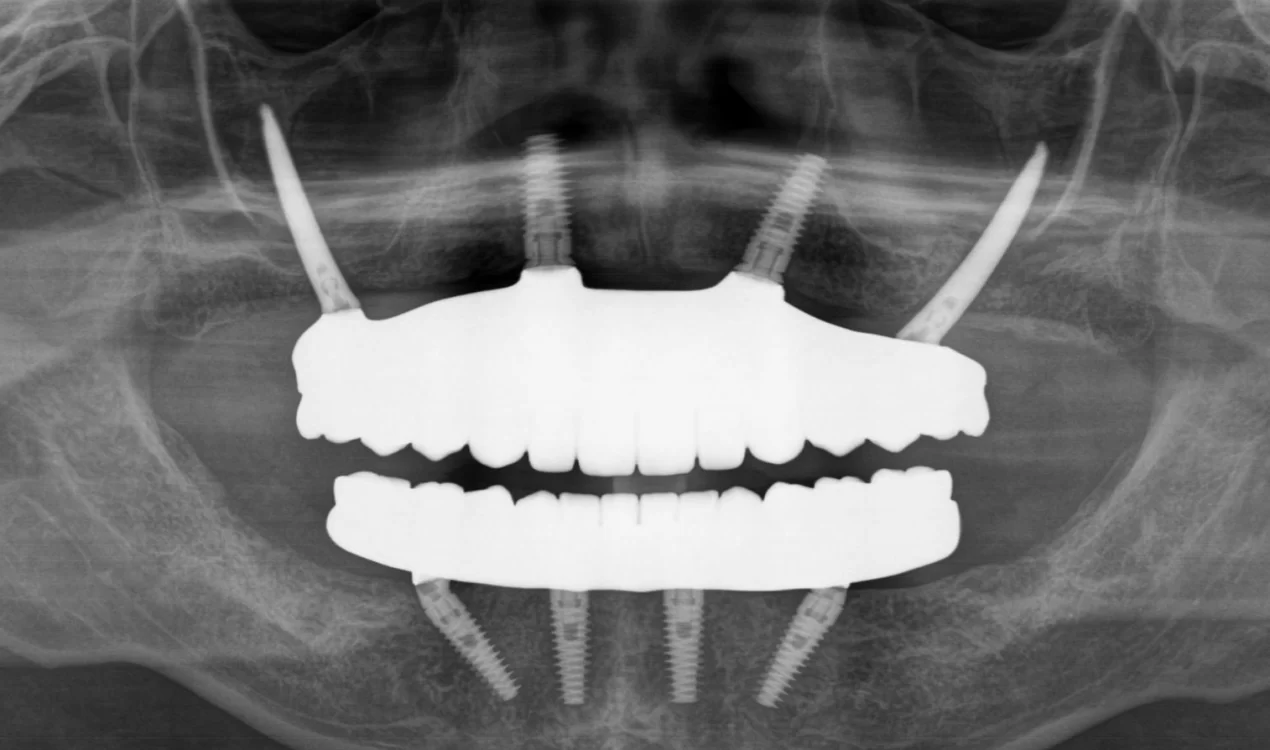 ザイゴマ2プランの対象：上顎の骨が少ない、1日で全部の歯を入れたい、最小限の負担で治療したい方へ