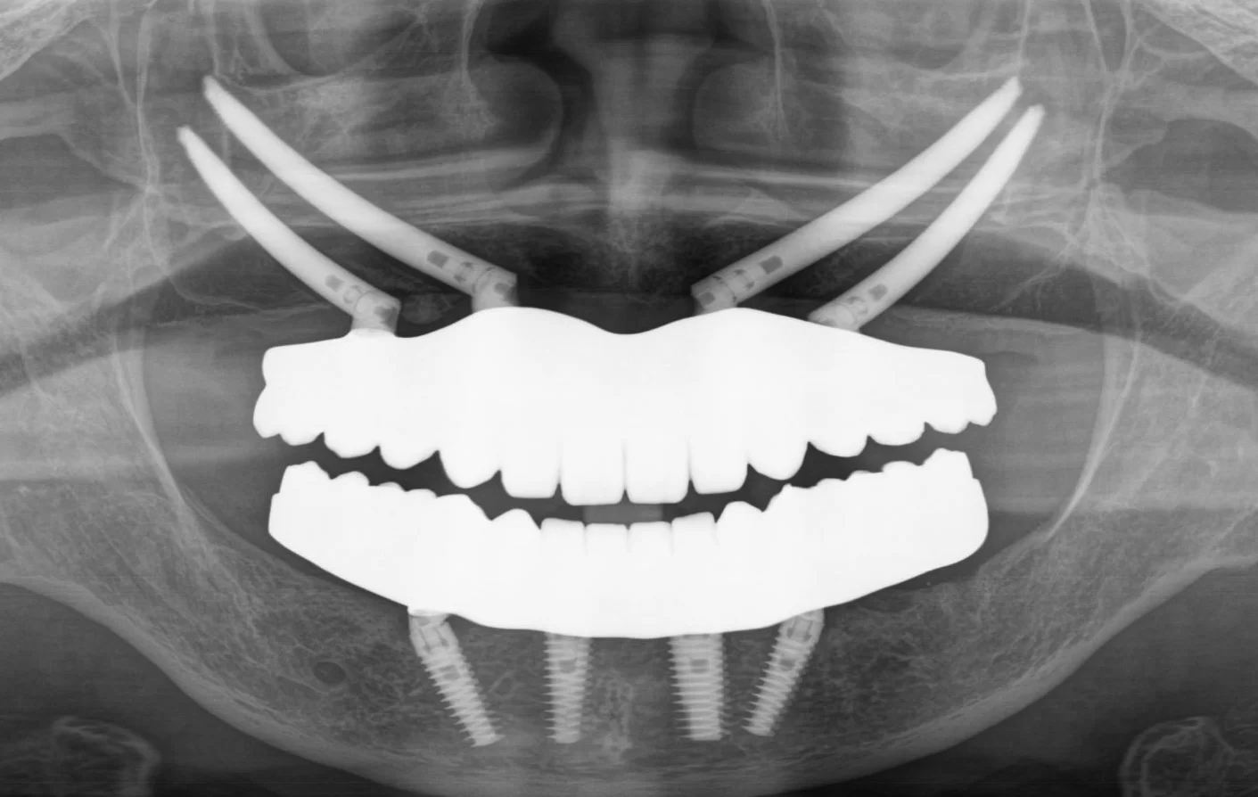 オールオン4ザイゴマ4プラン。上顎骨が全くない難症例に対応する、4本の頬骨インプラントを用いた全歯再建